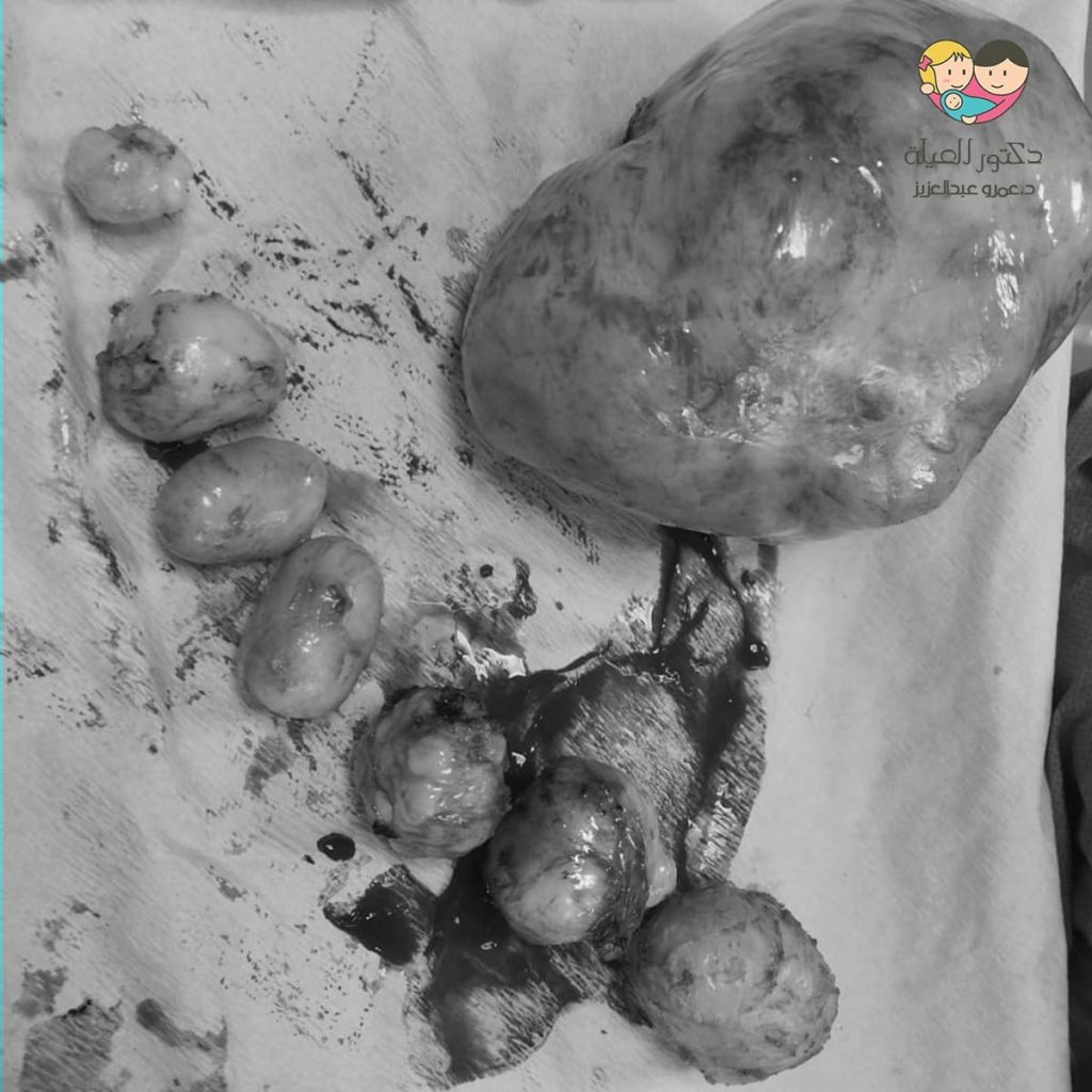 الاورام الليفية الكبيرة