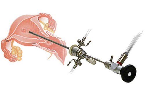 المنظار الرحمي وكل مايجب أن تعرفه عنه