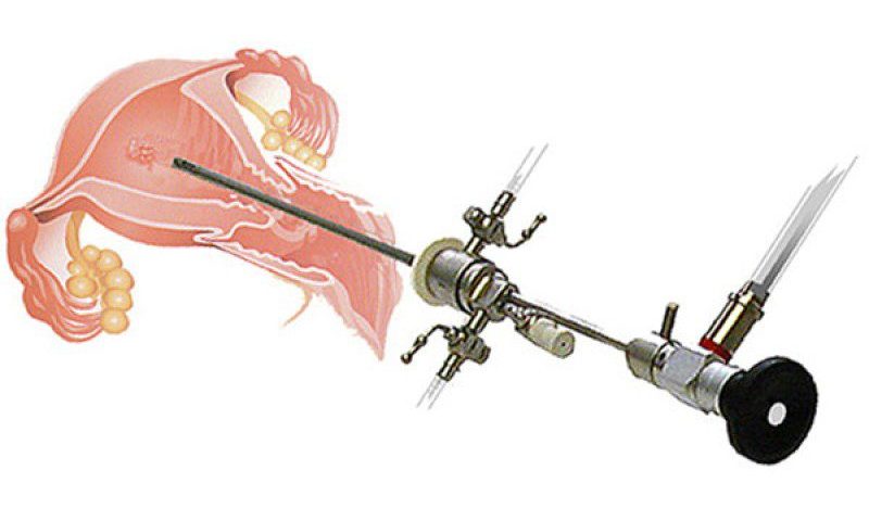 المنظار الرحمي