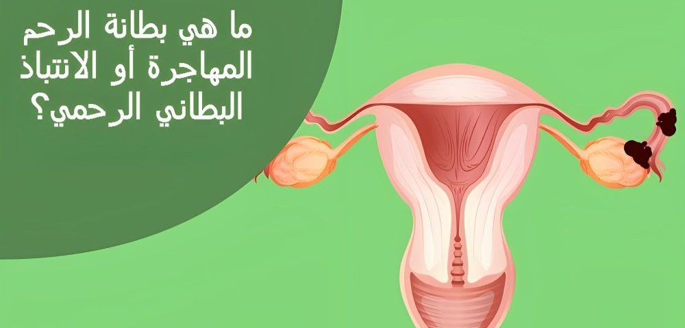 بطانة الرحم المهاجرة والحقن المجهري