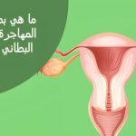 بطانة الرحم المهاجرة والحقن المجهري