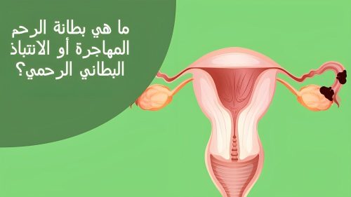 بطانة الرحم المهاجرة والحقن المجهري