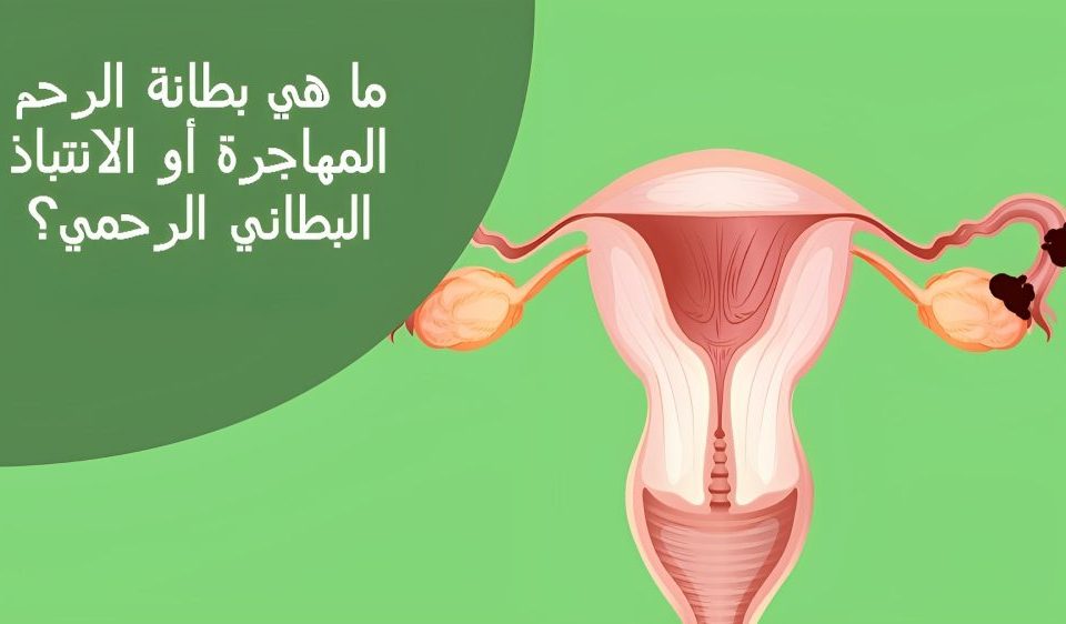 بطانة الرحم المهاجرة والحقن المجهري