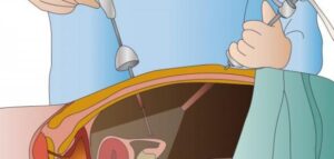 منظار الرحم للحقن المجهري