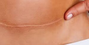 نصائح طبية قبل الولادة القيصرية