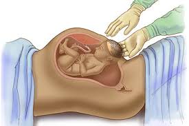 قبل الولادة القيصرية : نصائح طبية للحوامل
