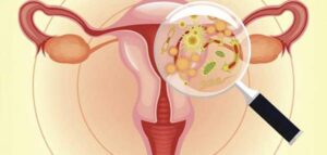 الالتهابات المهبلية