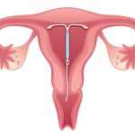 حمل على اللولب