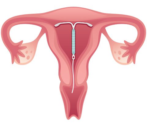 حمل على اللولب