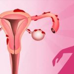 الدورة الشهرية بعد الولادة القيصرية