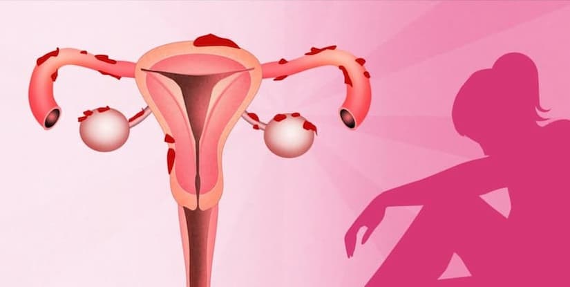 الدورة الشهرية بعد الولادة القيصرية