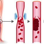 جلطات الحمل