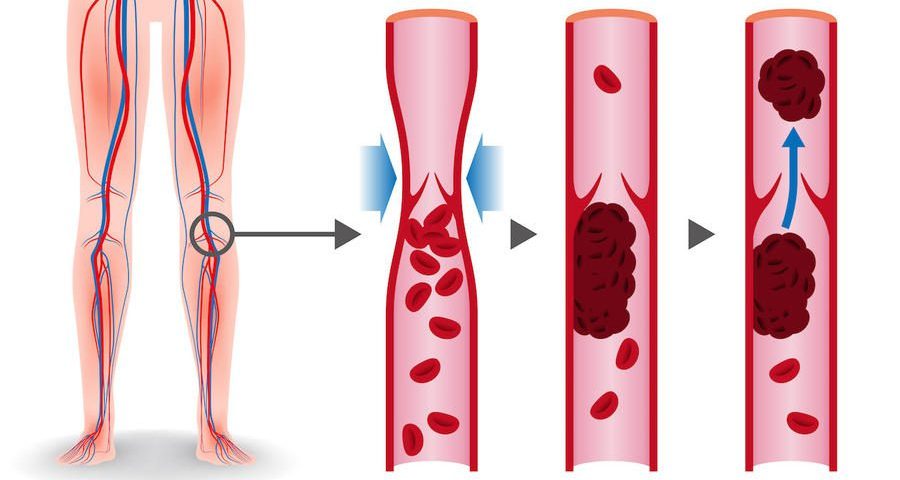 جلطات الحمل