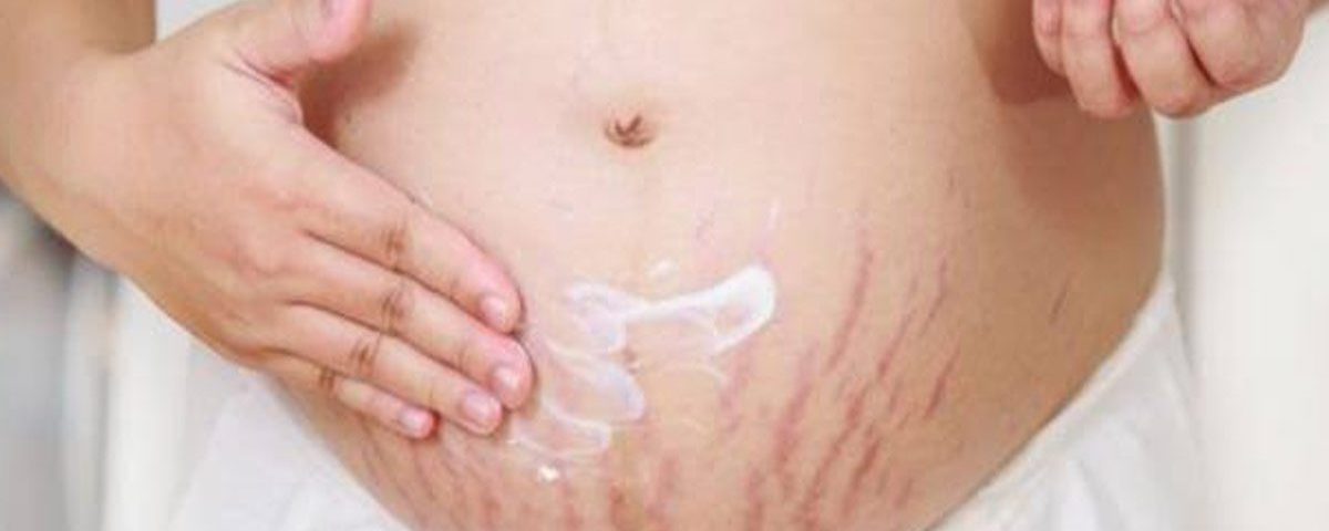 ترهل الجلد بعد الولادة