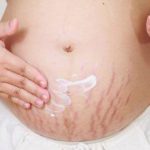 ترهل الجلد بعد الولادة