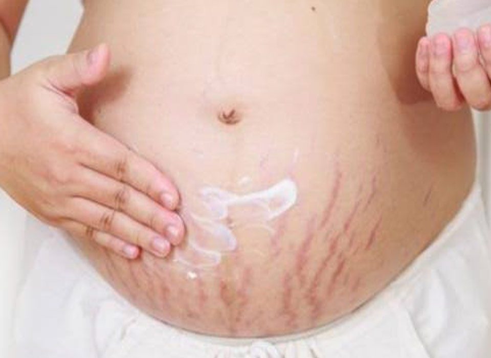 ترهل الجلد بعد الولادة