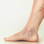 دوالي الساقين أثناء الحمل