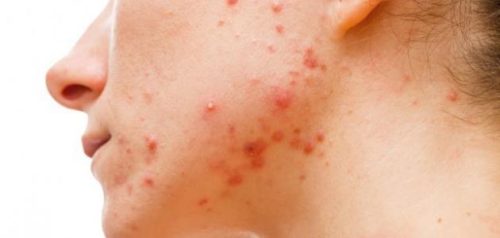 ما هي التغيرات الجلدية أثناء الحمل وكيفية العلاج منها؟