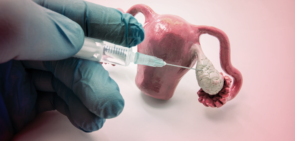 حقن البلازما للمبيض