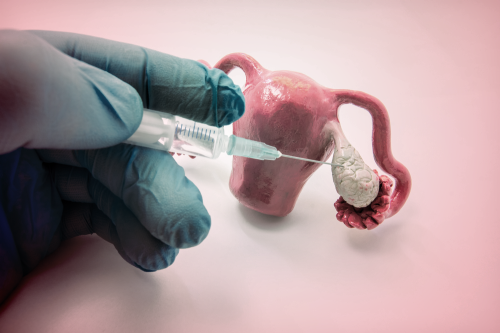 حقن البلازما للمبيض| هل يُمكن أن يكون فعّالًا؟