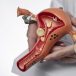 متلازمة تكيس المبايض| Polycystic Ovarian Syndrome