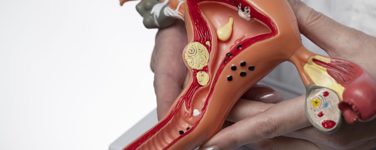 متلازمة تكيس المبايض