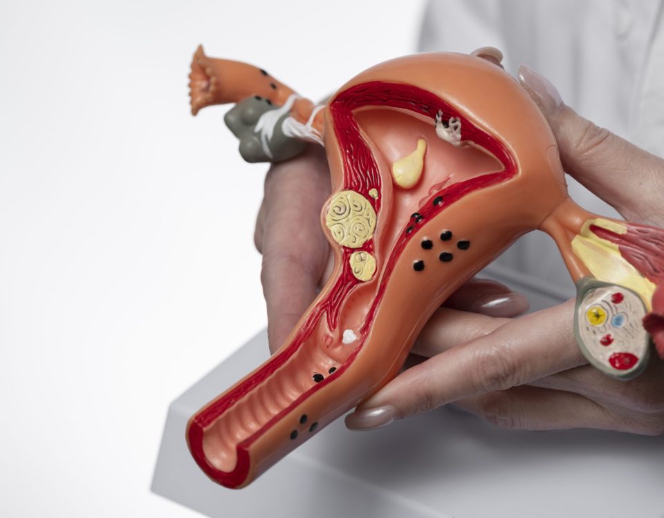 متلازمة تكيس المبايض