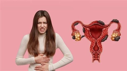 أكياس الشوكولاتة| أسبابها وأعراضها وكيفية علاجها