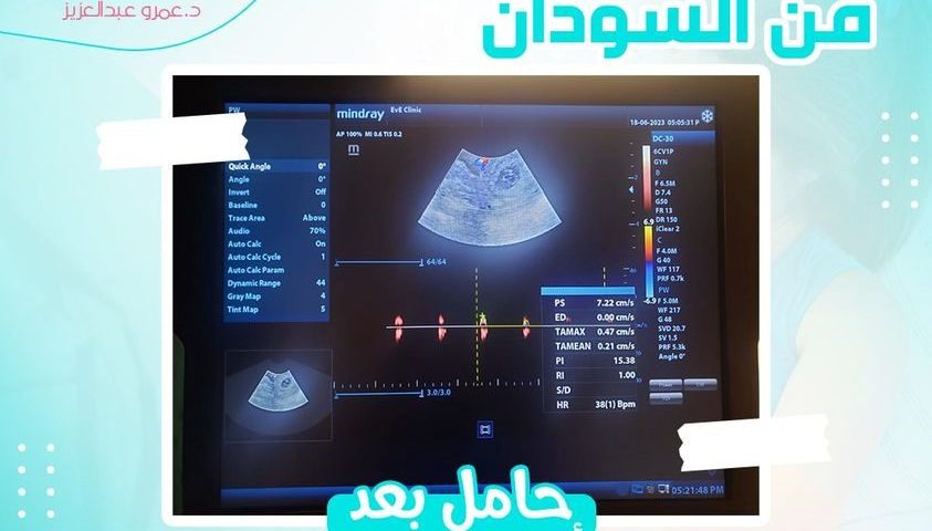 حامل بعد ضعف مخزون المبيض