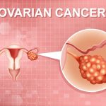 سرطان المبيض