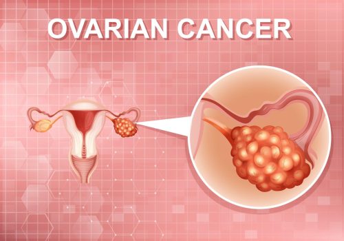سرطان المبيض| Ovarian Cancer